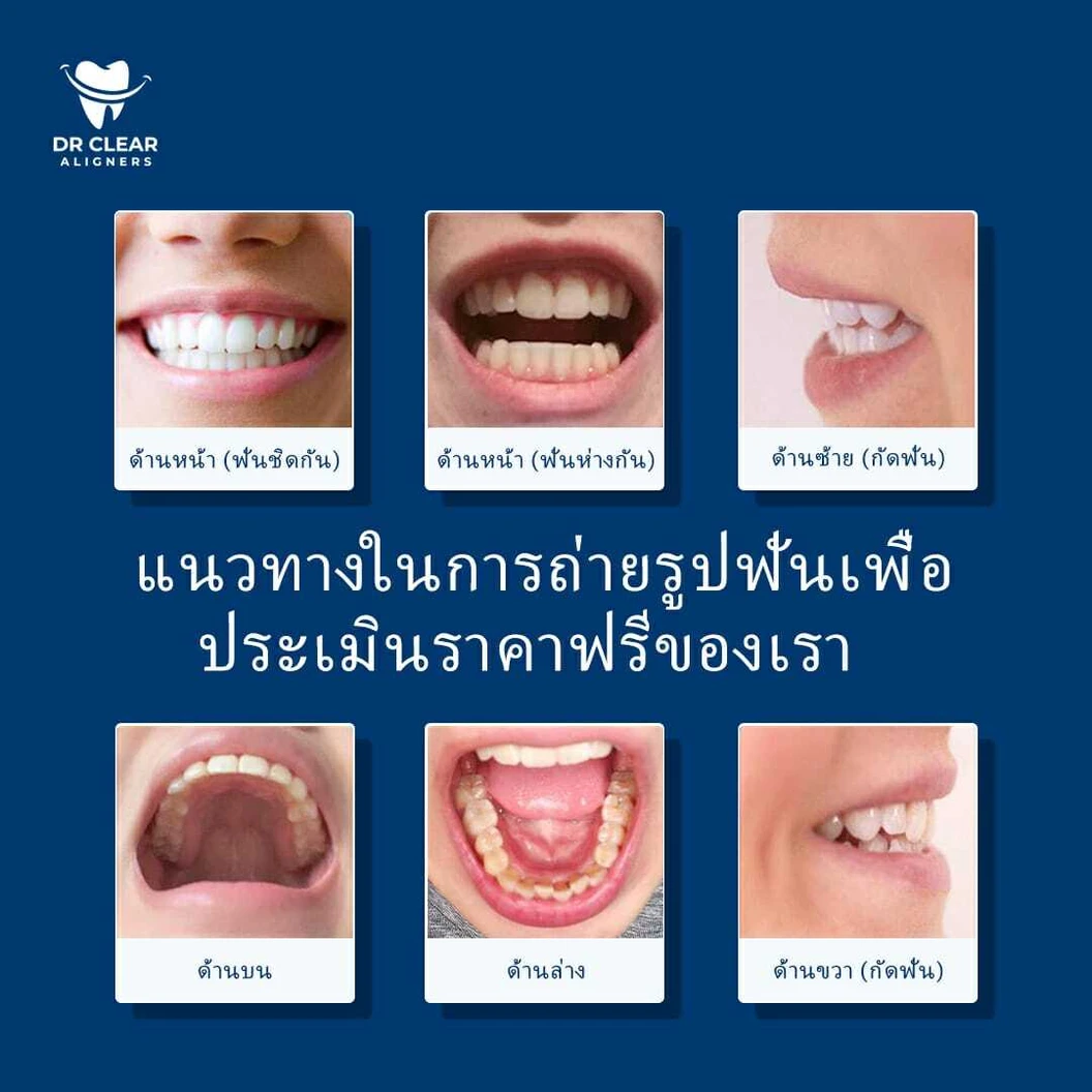 สแกนช่องปากด้วยระบบ 3D สำหรับจัดฟันแบบใส Dr. Clear Aligners