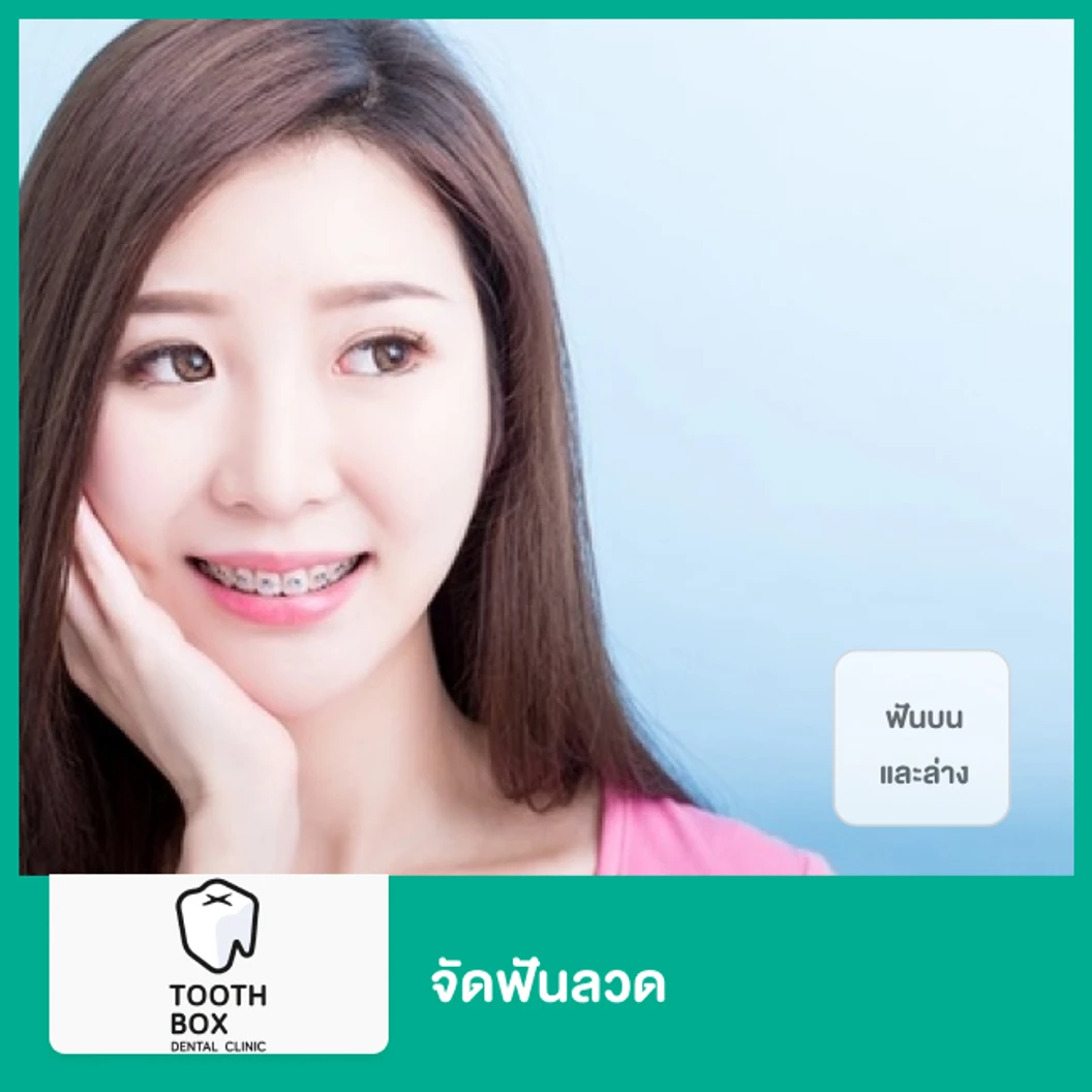 จัดฟันแบบโลหะ ฟันบนและล่าง