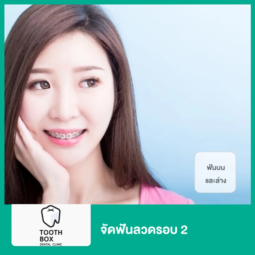 จัดฟันแบบโลหะรอบ 2 ฟันบนและล่าง
