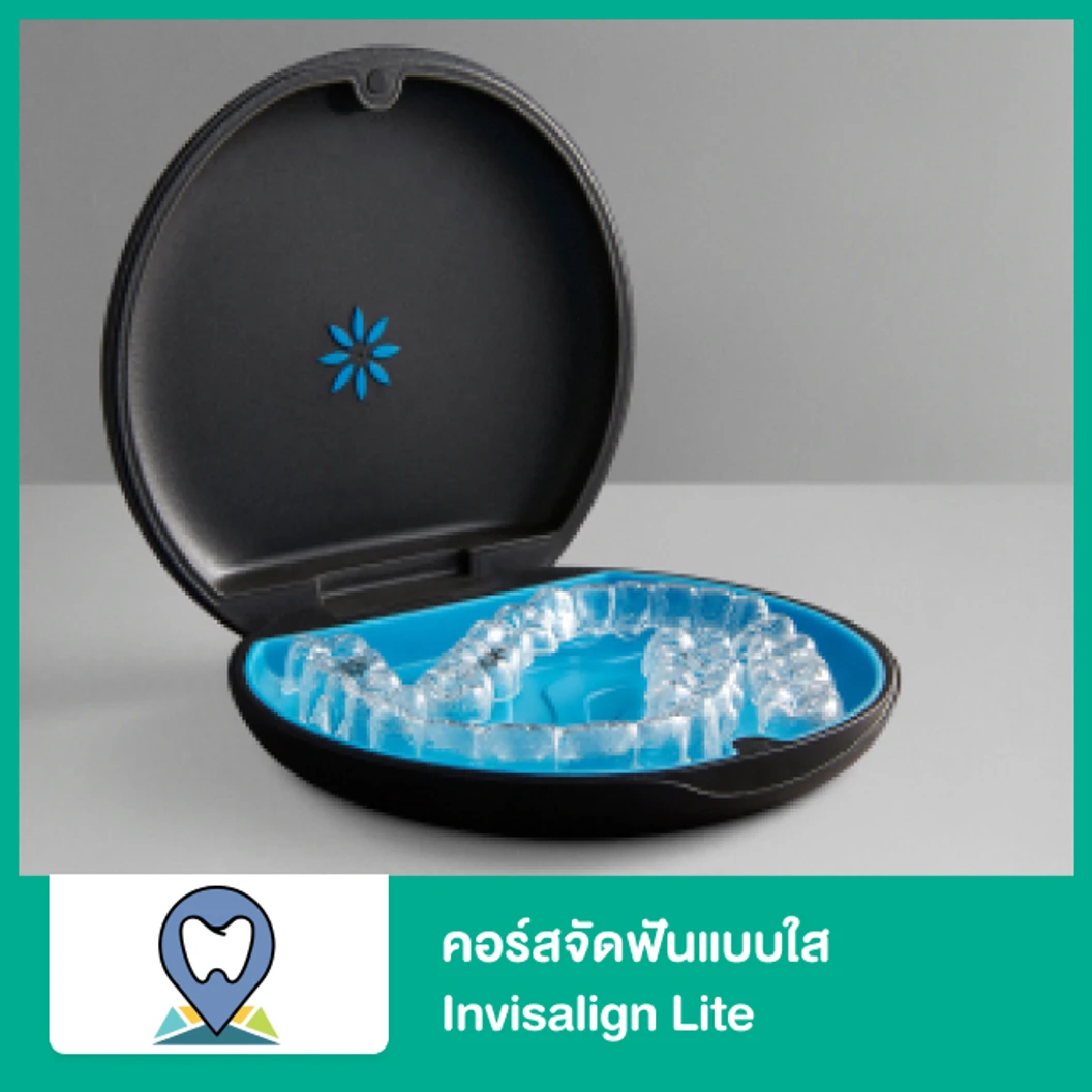 คอร์สจัดฟันแบบใส Invisalign Lite ฟันบนและล่าง