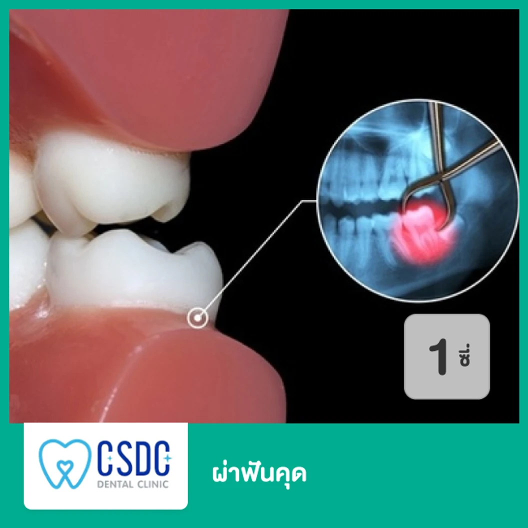 ผ่าฟันคุด 1 ซี่ เฉพาะสาขาลาดพร้าวเท่านั้น