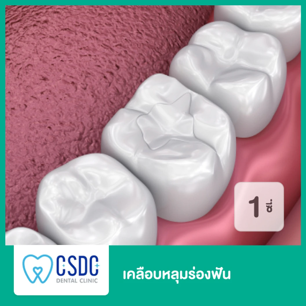 เคลือบหลุมร่องฟัน สำหรับฟัน 1 ซี่ เฉพาะสาขา ม.เกษตรเท่านั้น
