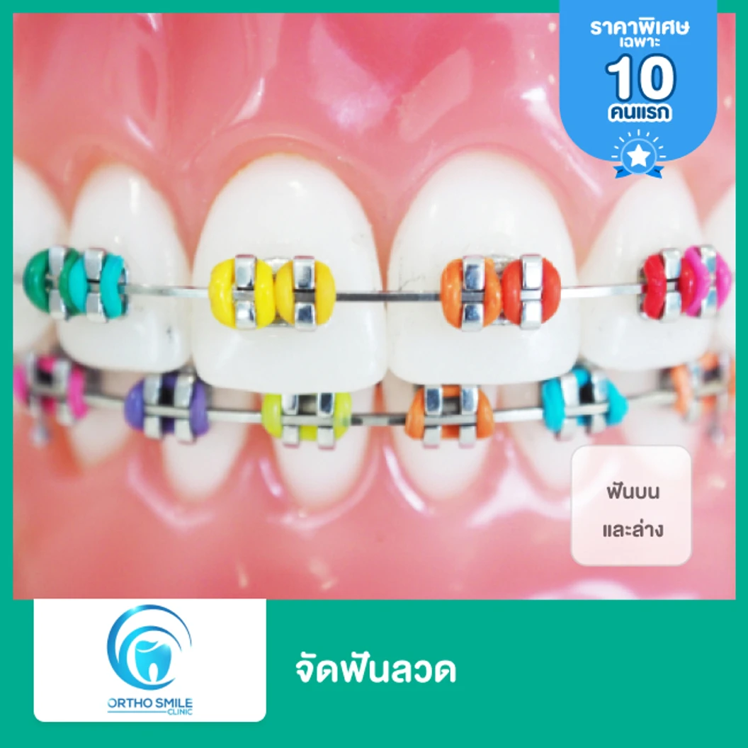 จัดฟันแบบโลหะ ฟันบนและล่าง