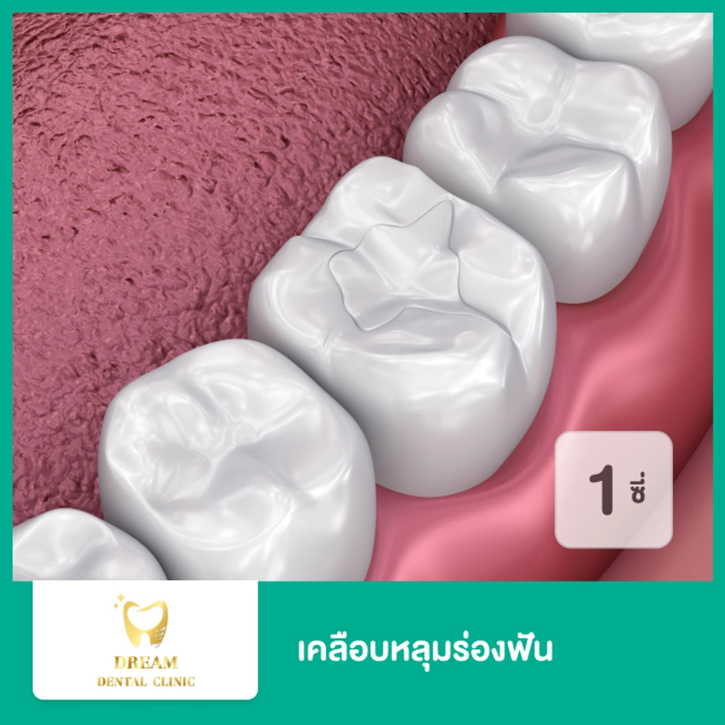 เคลือบหลุมร่องฟัน สำหรับฟัน 1 ซี่