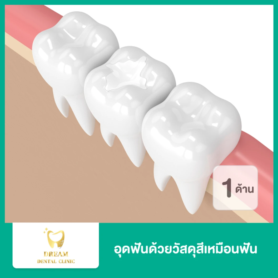อุดฟัน 1 ด้าน ด้วยวัสดุสีเหมือนฟัน