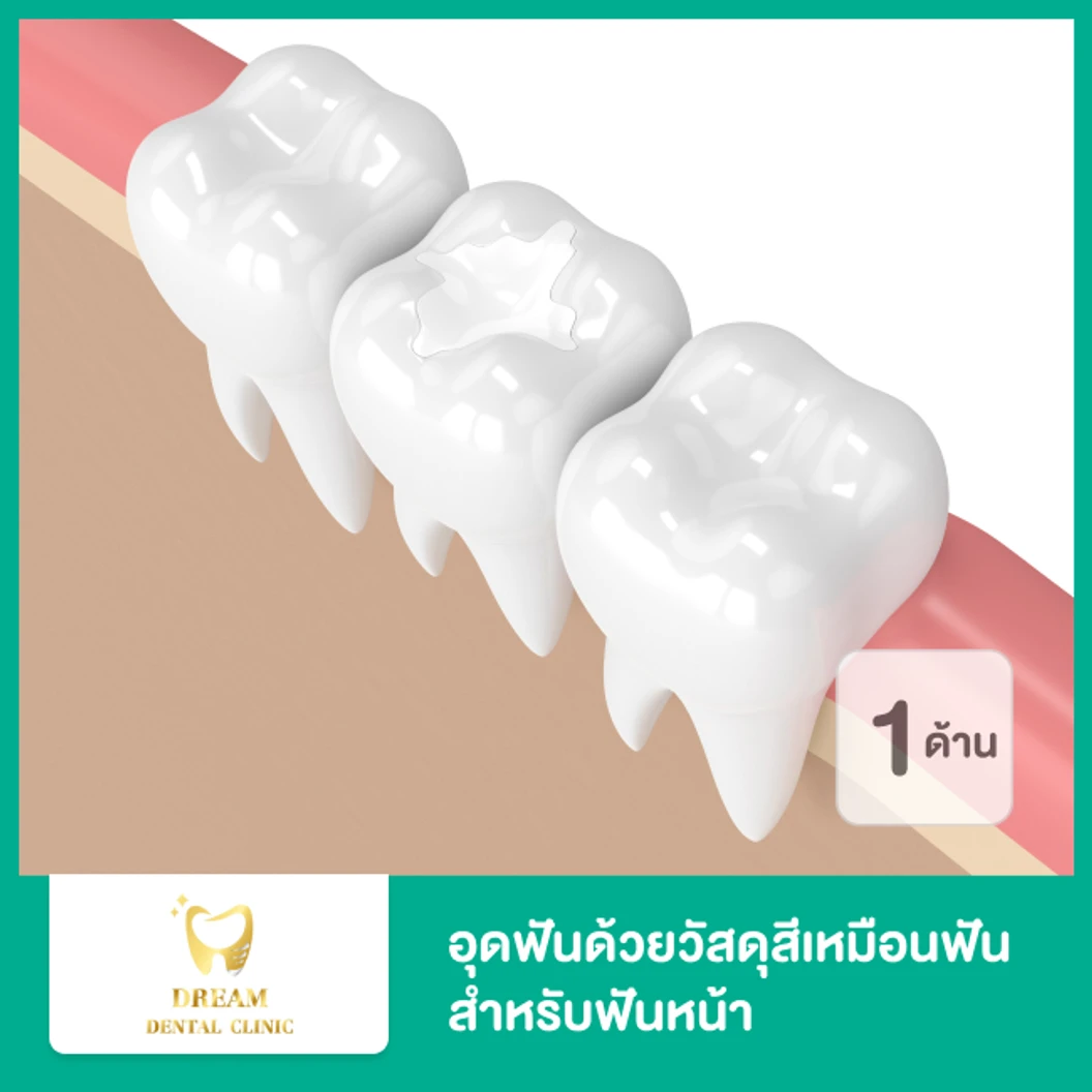 อุดฟันหน้า 1 ด้าน ด้วยวัสดุสีเหมือนฟัน