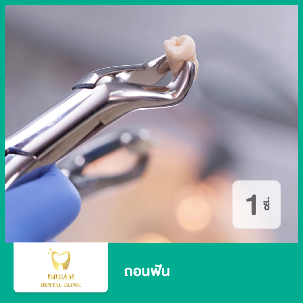 ถอนฟัน 1 ซี่