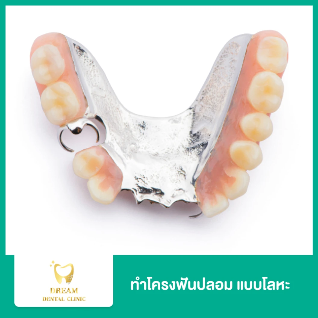 ทำโครงฟันปลอม แบบโลหะ ชนิดถอดได้ พร้อมฟันซี่แรก 1 ซี่