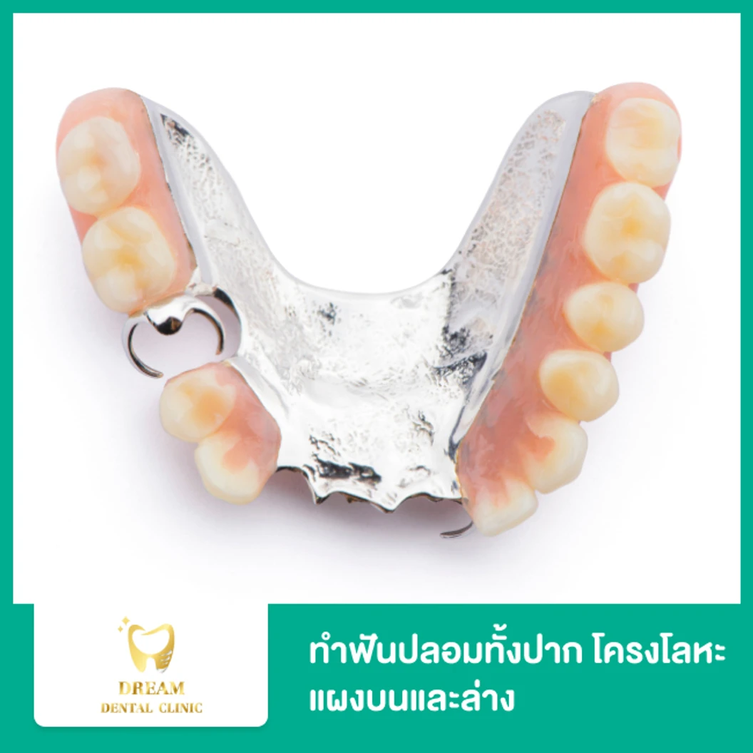 ทำฟันปลอมทั้งปาก โครงโลหะ แผงบนและล่าง 2 ชิ้น