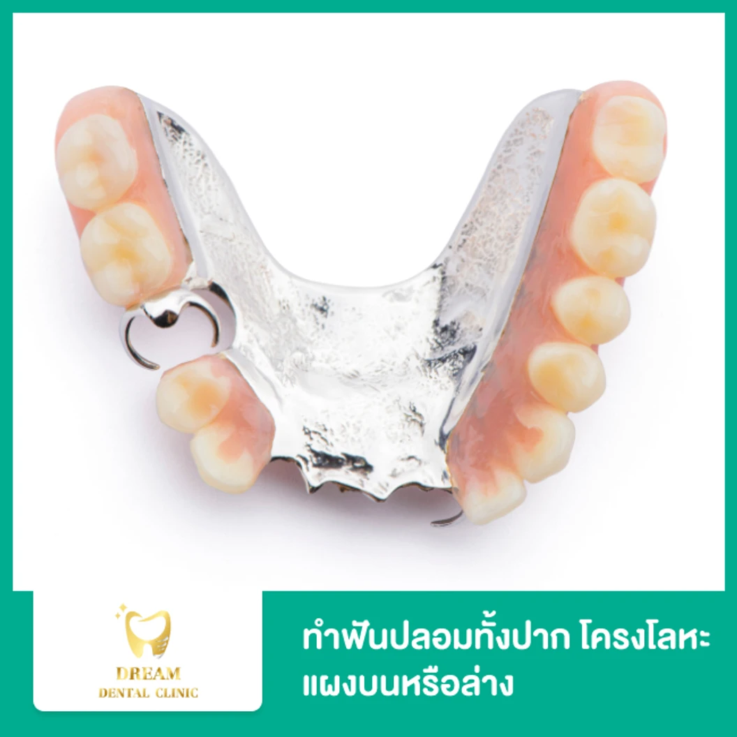 ทำฟันปลอมทั้งปาก โครงโลหะ แผงบนหรือล่าง 1 ชิ้น