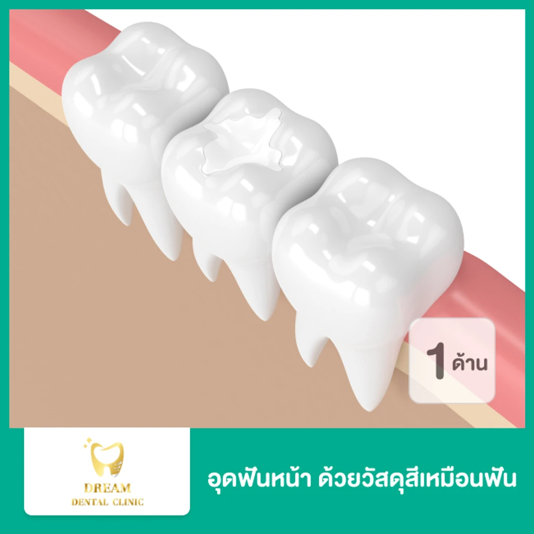 อุดฟันน้ำนม 1 ด้าน ด้วยวัสดุสีเหมือนฟัน
