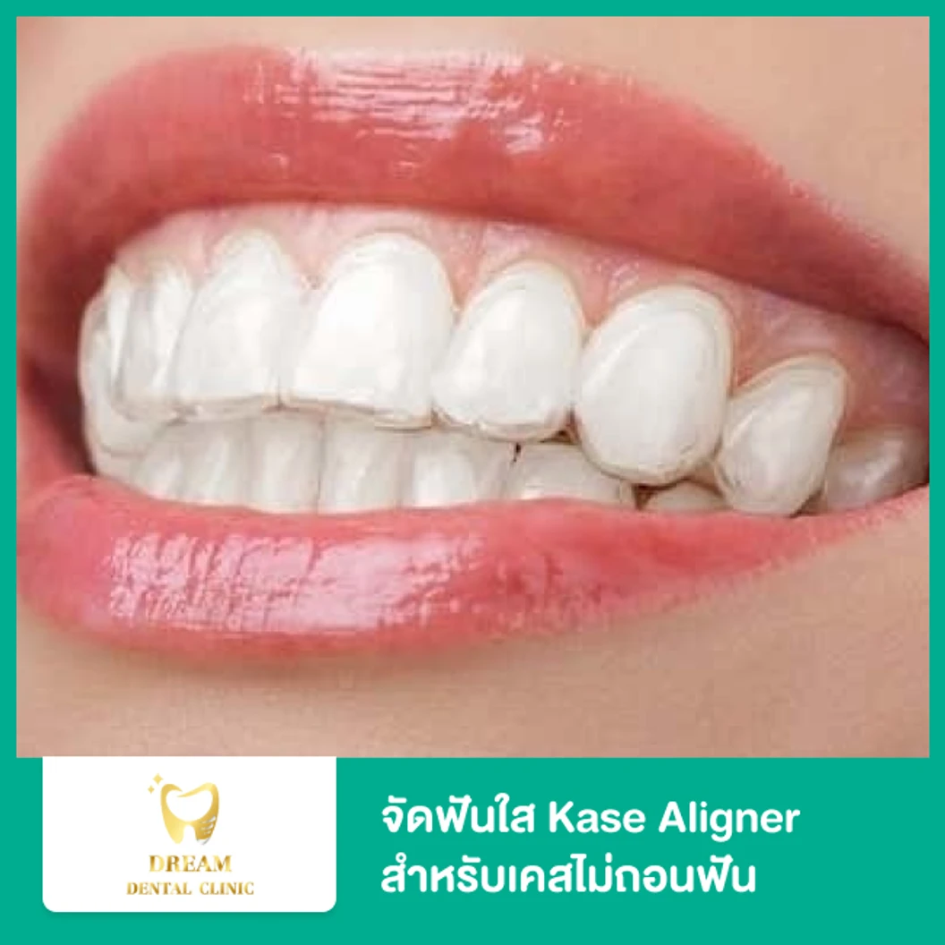 จัดฟันใส Kase Aligner ฟันบนและล่าง สำหรับเคสไม่ถอนฟัน