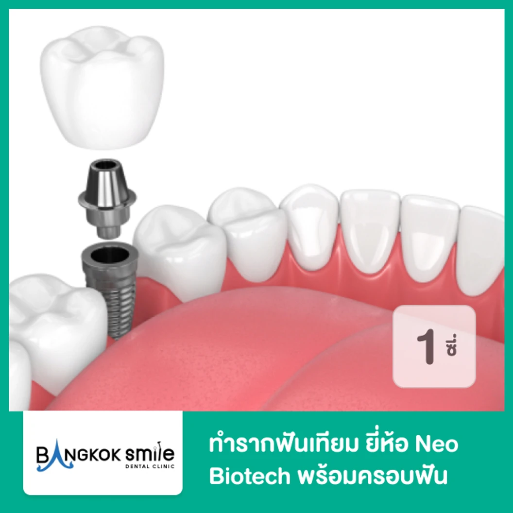ทำรากฟันเทียม ยี่ห้อ Neo Biotech พร้อมครอบฟัน สำหรับฟัน 1 ซี่