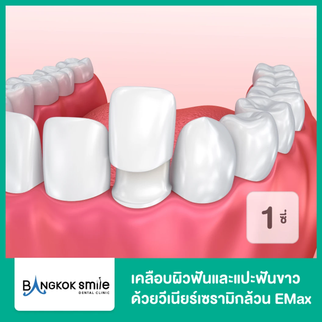 เคลือบผิวฟันและแปะฟันขาว ด้วยวีเนียร์เซรามิกล้วน EMax 1 ซี่