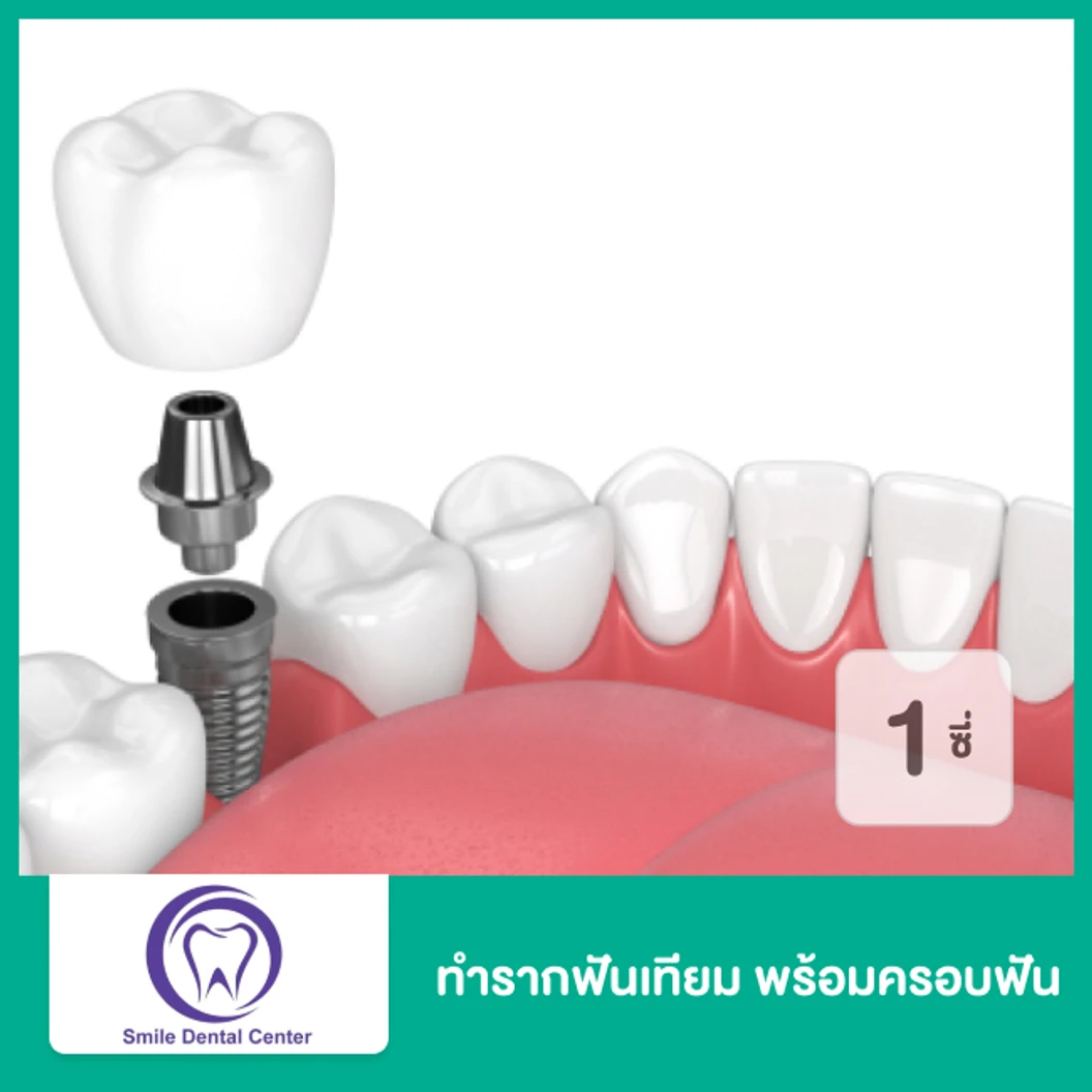 ทำรากฟันเทียม ยี่ห้อ Neo Biotech พร้อมครอบฟัน สำหรับฟัน 1 ซี่