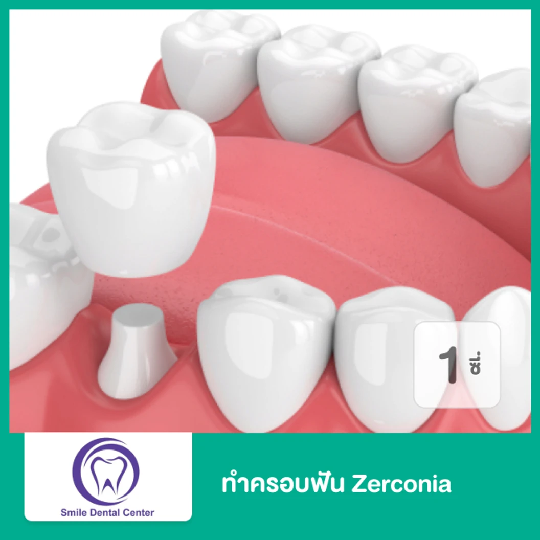 ทำครอบฟัน Zirconia เซรามิกล้วน สำหรับฟัน 1 ซี่