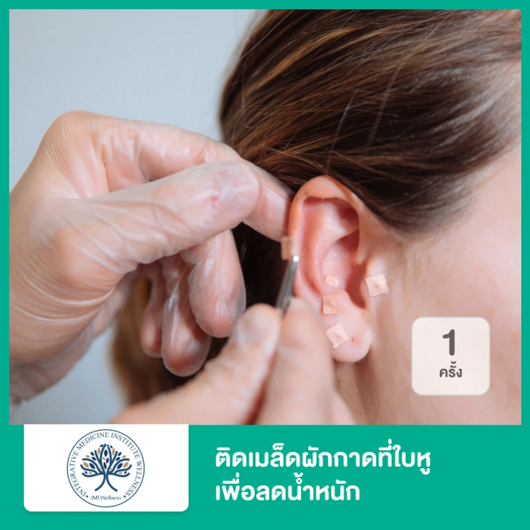 ติดเมล็ดผักกาดที่ใบหูเพื่อลดน้ำหนัก 1 ครั้ง