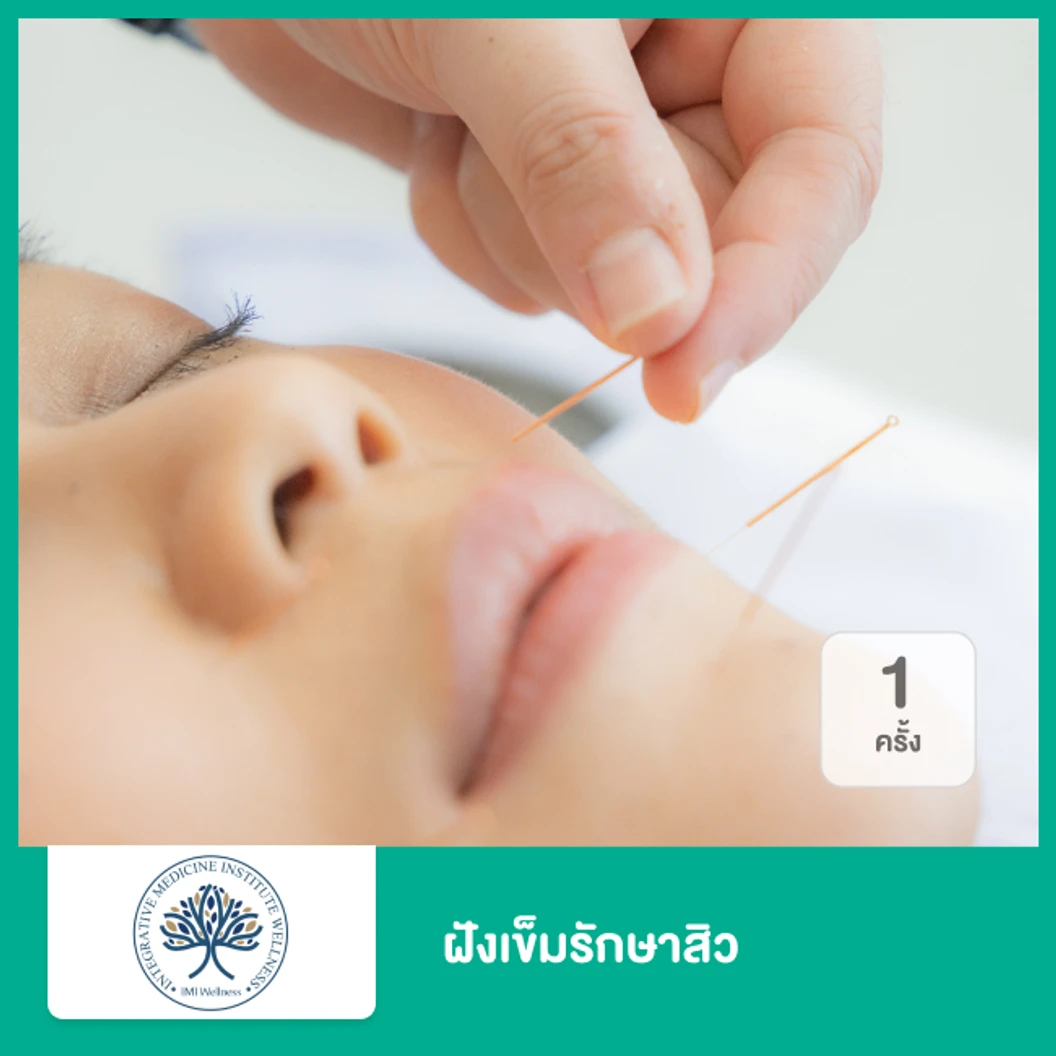 ฝังเข็มรักษาสิว 1 ครั้ง