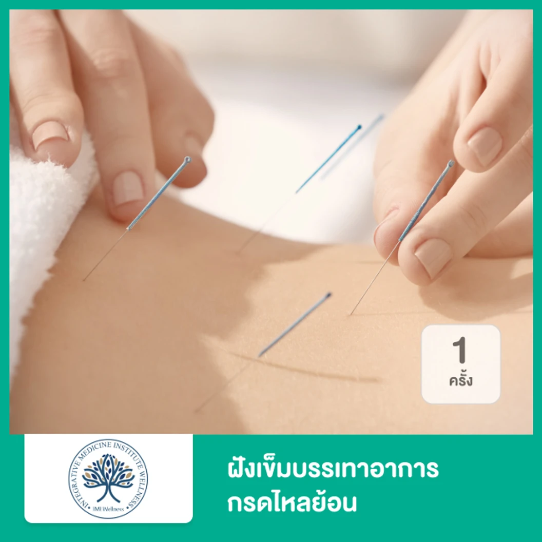 ฝังเข็มบรรเทาอาการกรดไหลย้อน 1 ครั้ง