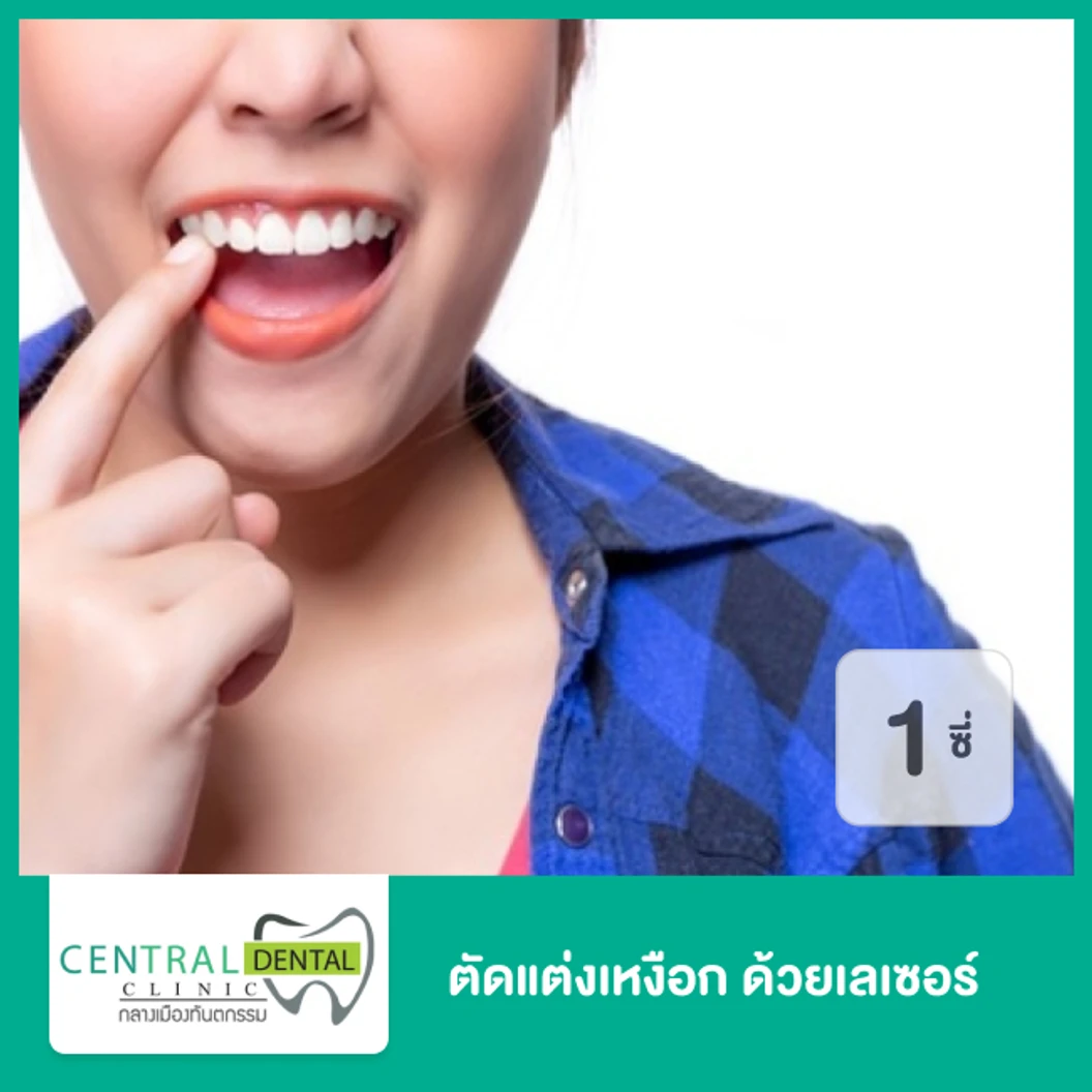 ตัดแต่งเหงือก ด้วยเลเซอร์ สำหรับฟัน 1 ซี่