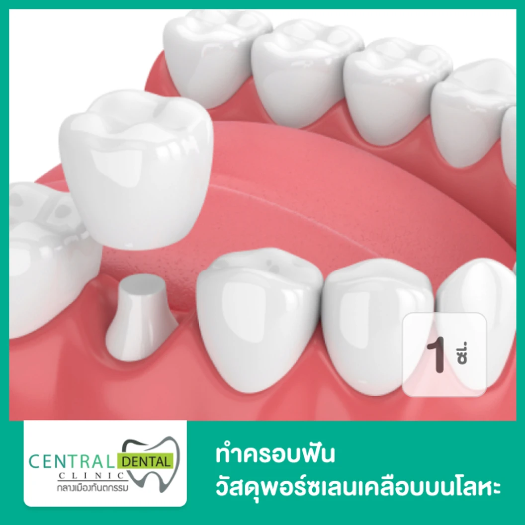 ทำครอบฟัน วัสดุพอร์ซเลนเคลือบบนโลหะ สำหรับฟัน 1 ซี่