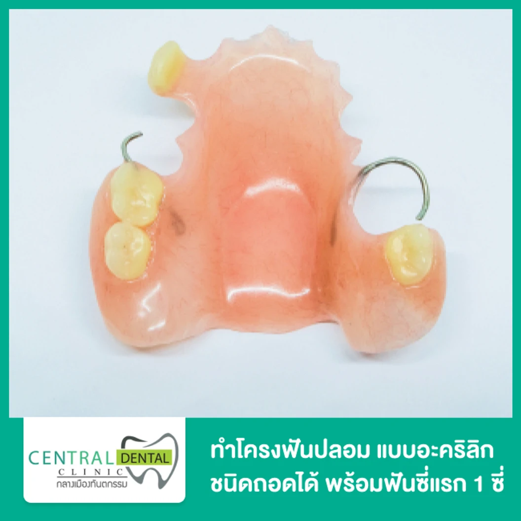 ทำโครงฟันปลอม แบบอะคริลิก ชนิดถอดได้ พร้อมฟันซี่แรก 1 ซี่