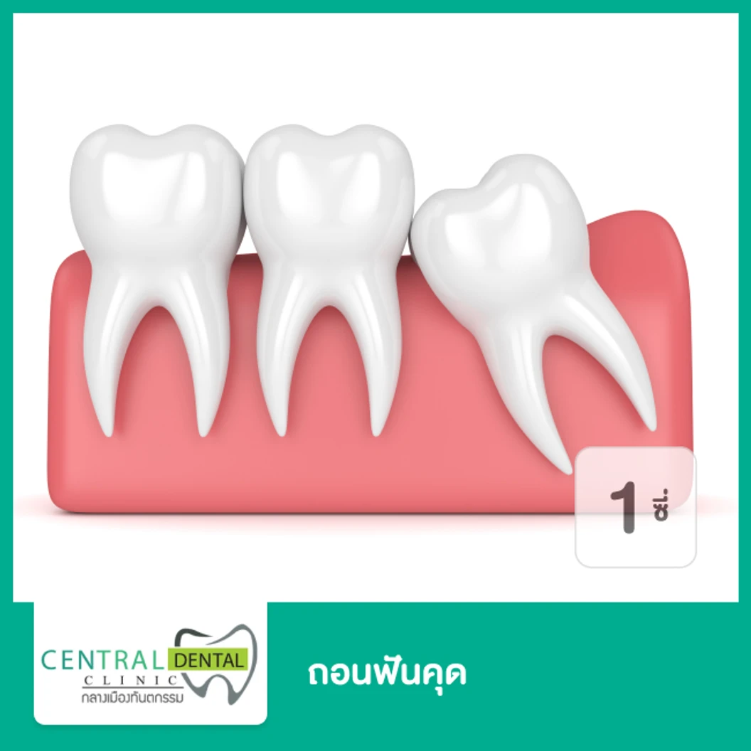 ถอนฟันคุด 1 ซี่