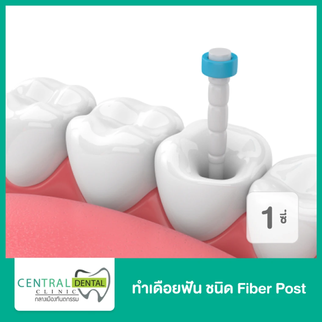 ทำเดือยฟัน ชนิด Fiber Post สำหรับฟัน 1 ซี่