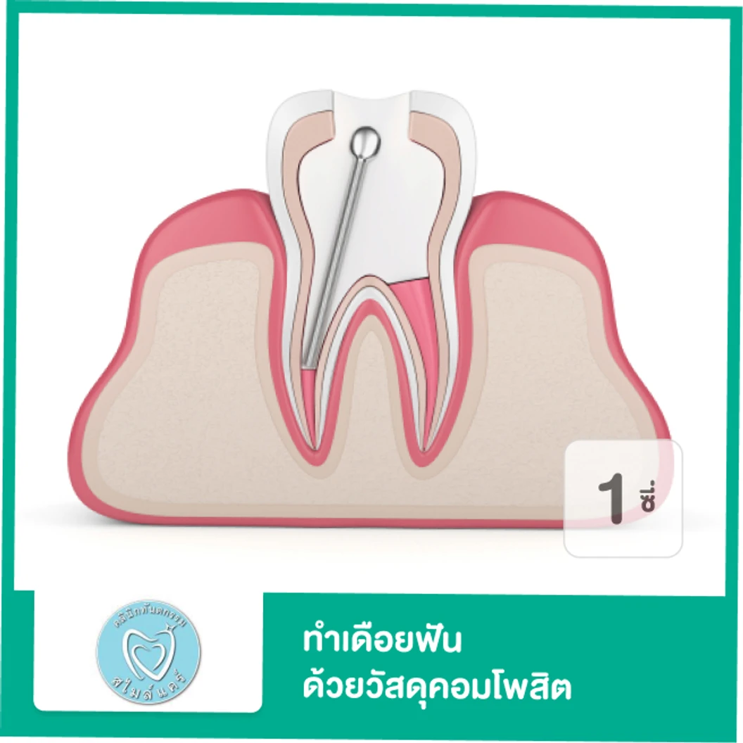 ทำเดือยฟัน ด้วยวัสดุคอมโพสิต สำหรับฟัน 1 ซี่