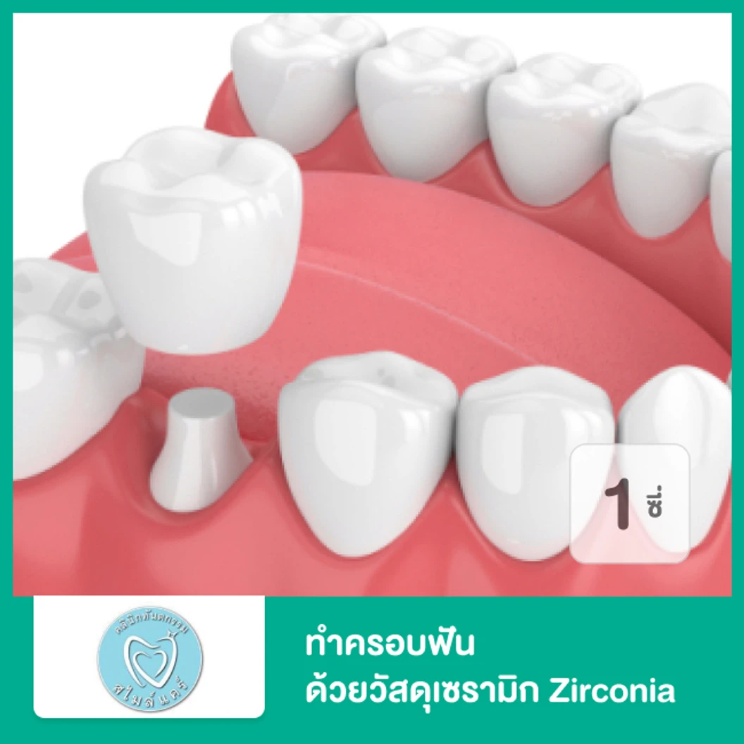 ทำครอบฟัน ด้วยวัสดุเซรามิก Zirconia สำหรับฟัน 1 ซี่