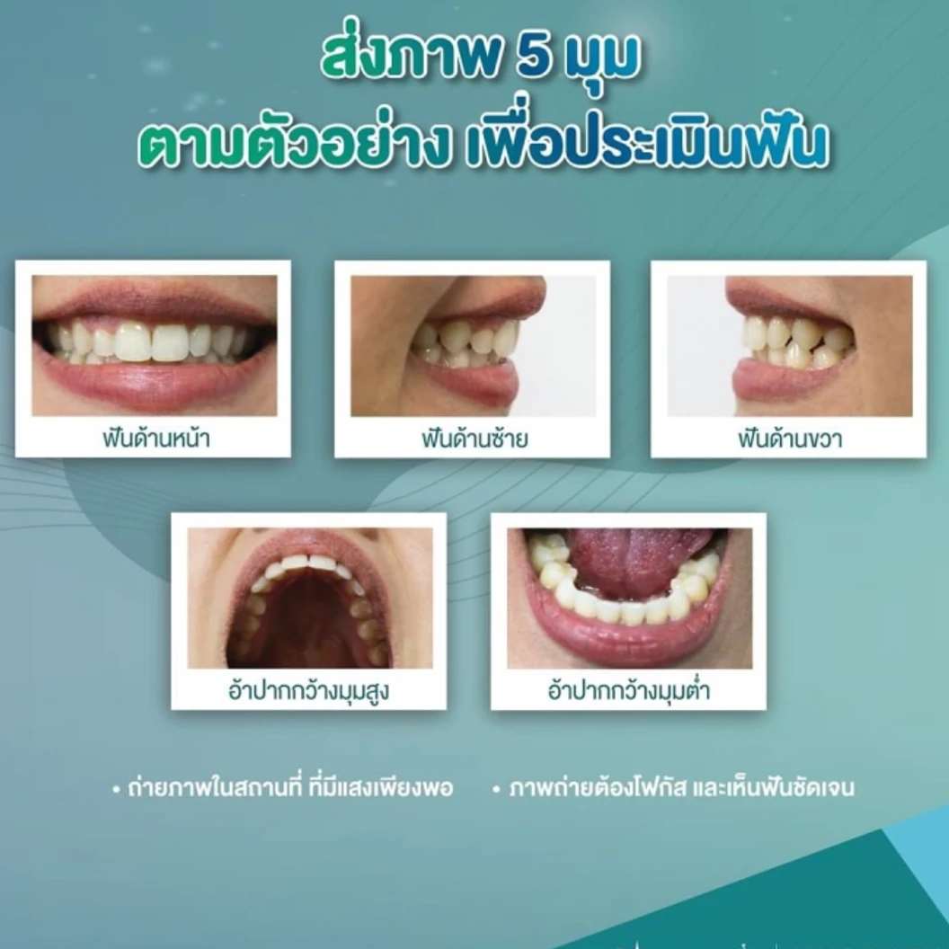 คอร์สจัดฟันแบบใส Crystal Smile Moderate ฟันบนและล่าง เครื่องมือไม่เกิน 20 ชิ้น