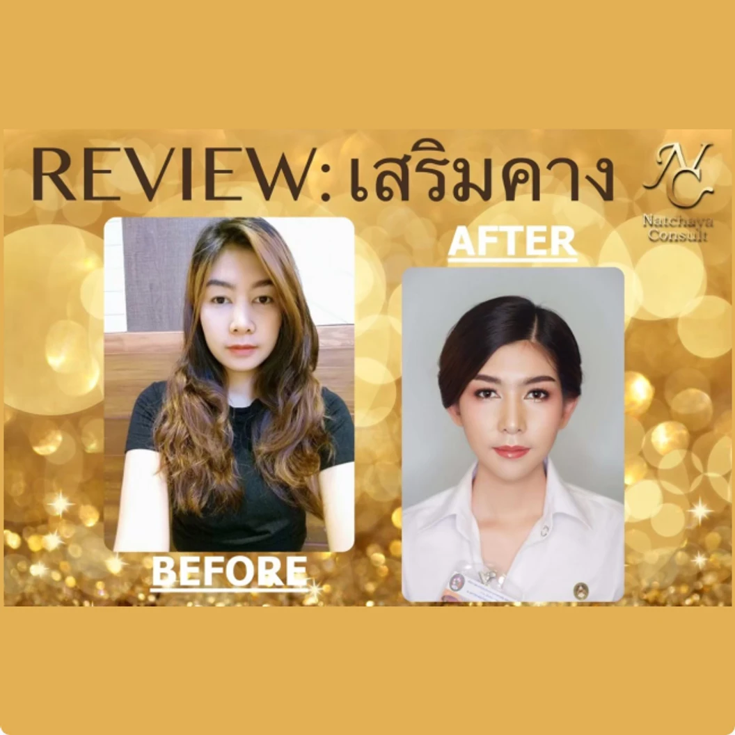 เสริมคางด้วยซิลิโคน เกรดพรีเมียม (เทคนิคแผลนอก)