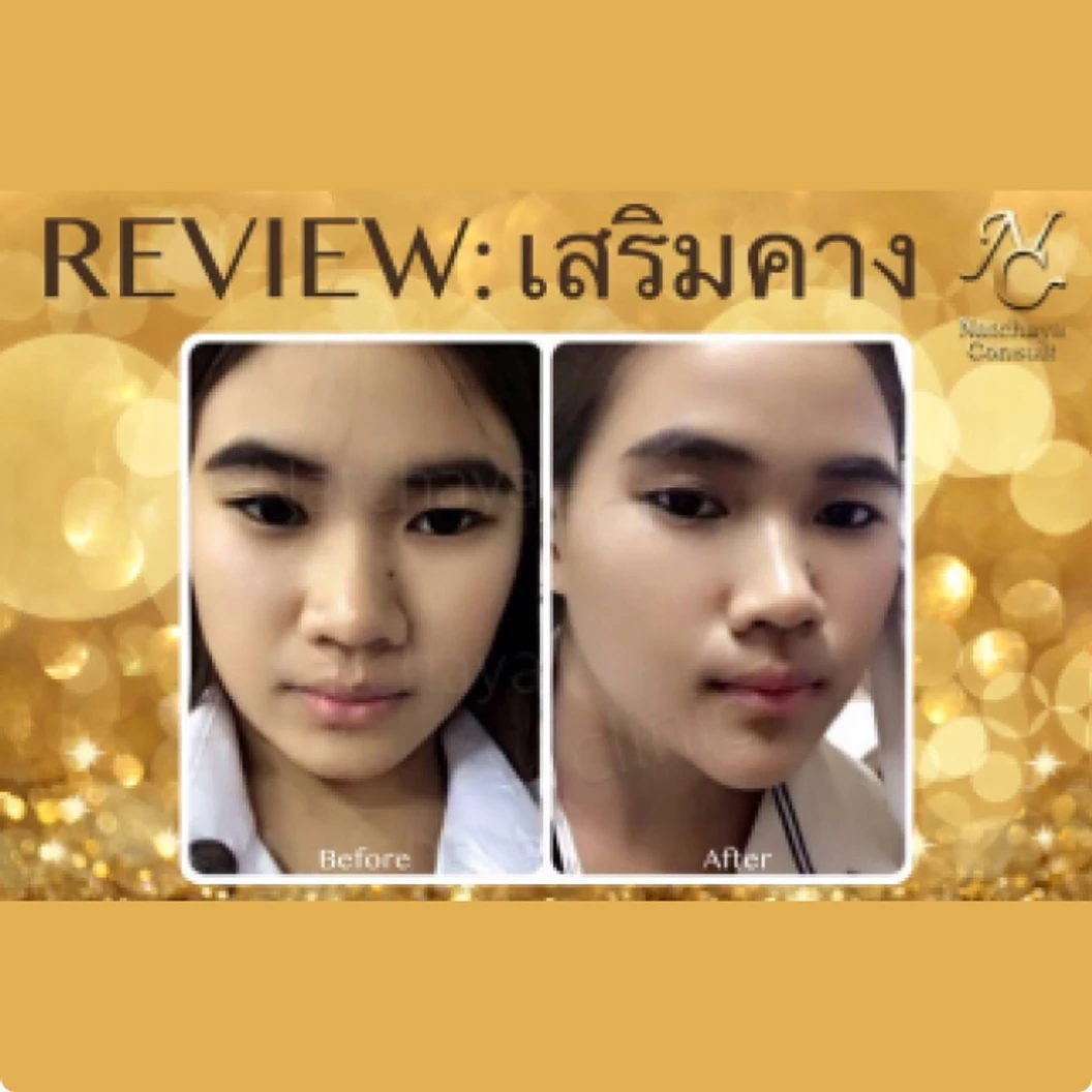 เสริมคางด้วยซิลิโคน เกรดพรีเมียม (เทคนิคแผลนอก)