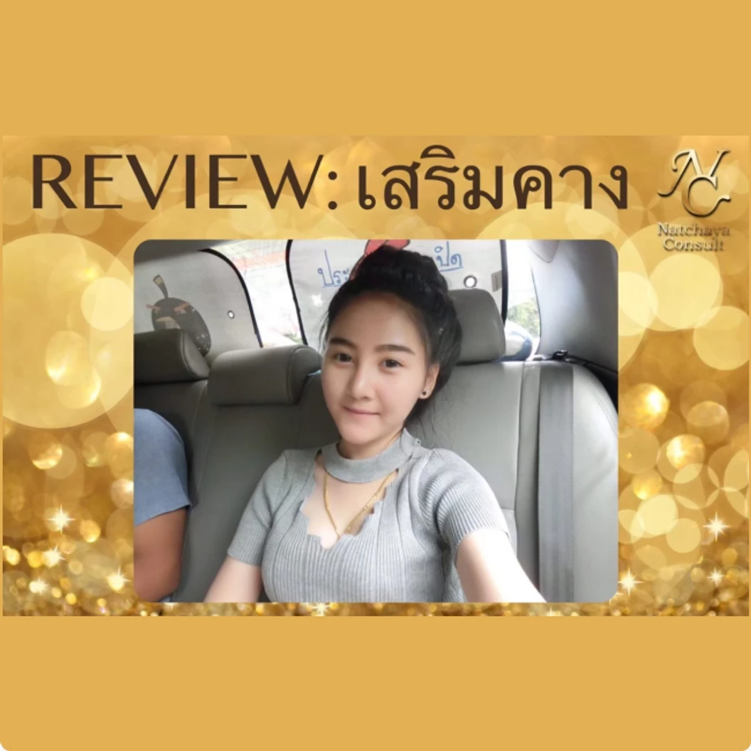 เสริมคางด้วยซิลิโคน เกรดพรีเมียม (เทคนิคแผลนอก)
