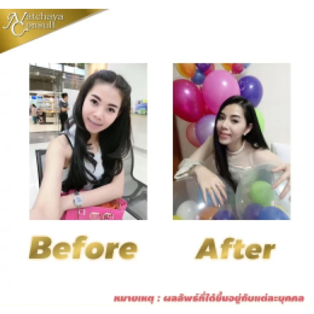 เสริมคางด้วยซิลิโคน เกรดพรีเมียม (เทคนิคแผลนอก)