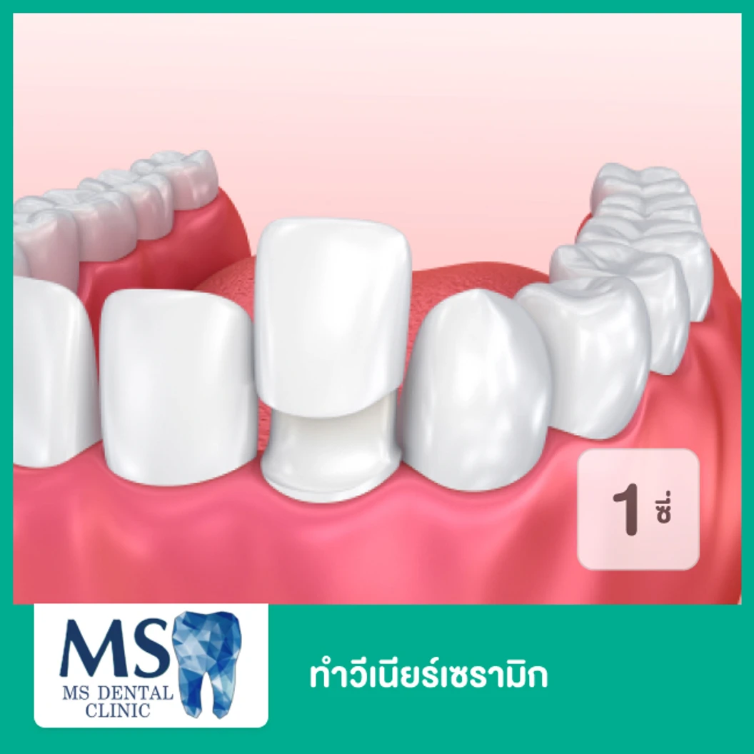 ทำวีเนียร์เซรามิก สำหรับฟัน 1 ซี่