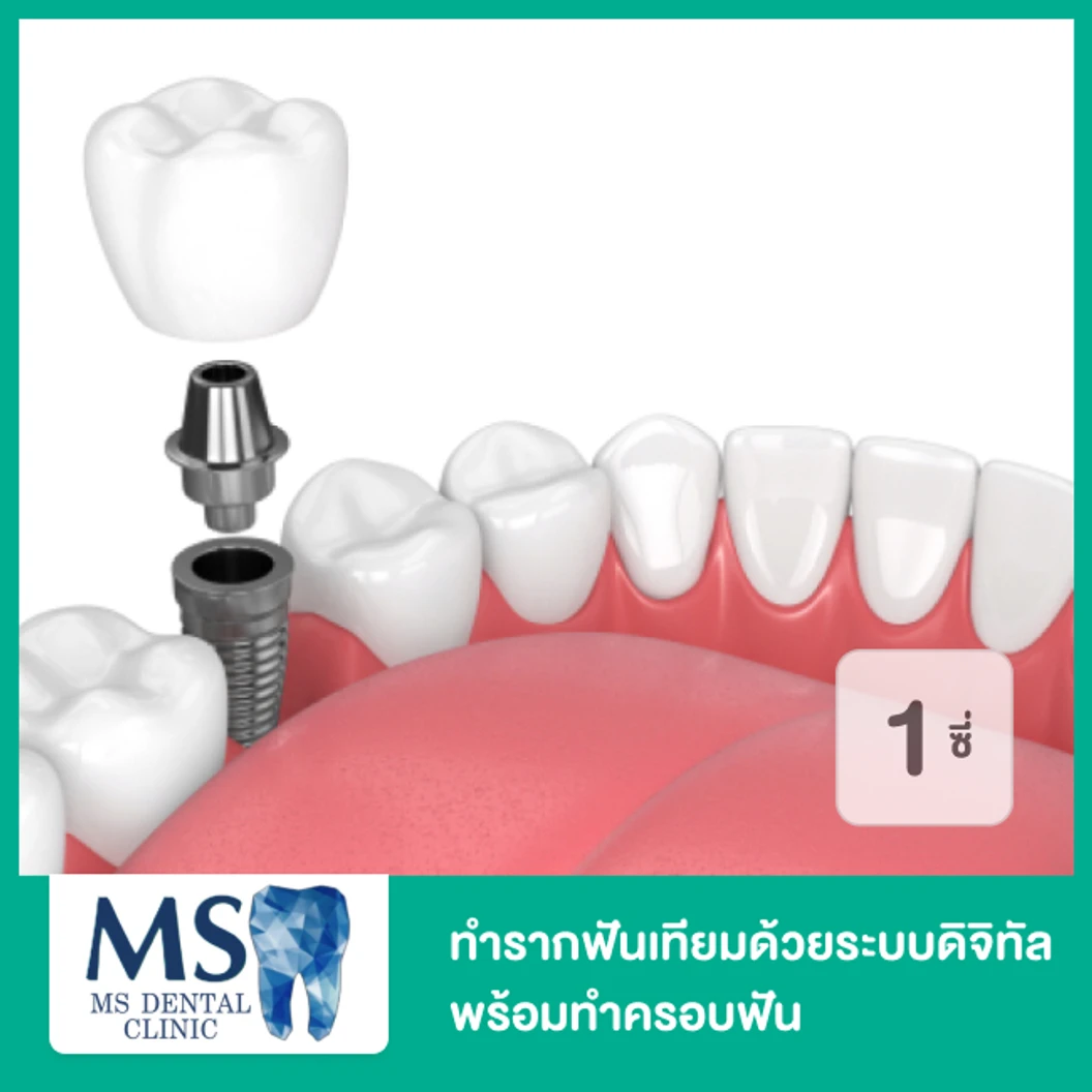 ทำรากฟันเทียมด้วยระบบดิจิทัล ยี่ห้อ Dentium พร้อมทำครอบฟันด้วยวัสดุสีเหมือนฟัน 1 ซี่