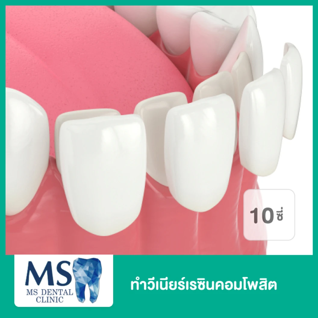 ทำวีเนียร์เรซินคอมโพสิต สำหรับฟัน 10 ซี่