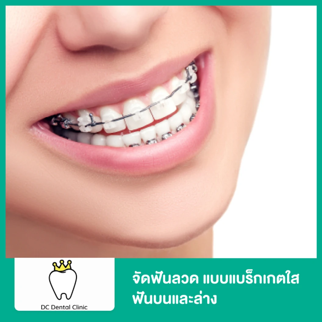 จัดฟันแบบโลหะ แบบแบร็กเกตใส ฟันบนและล่าง