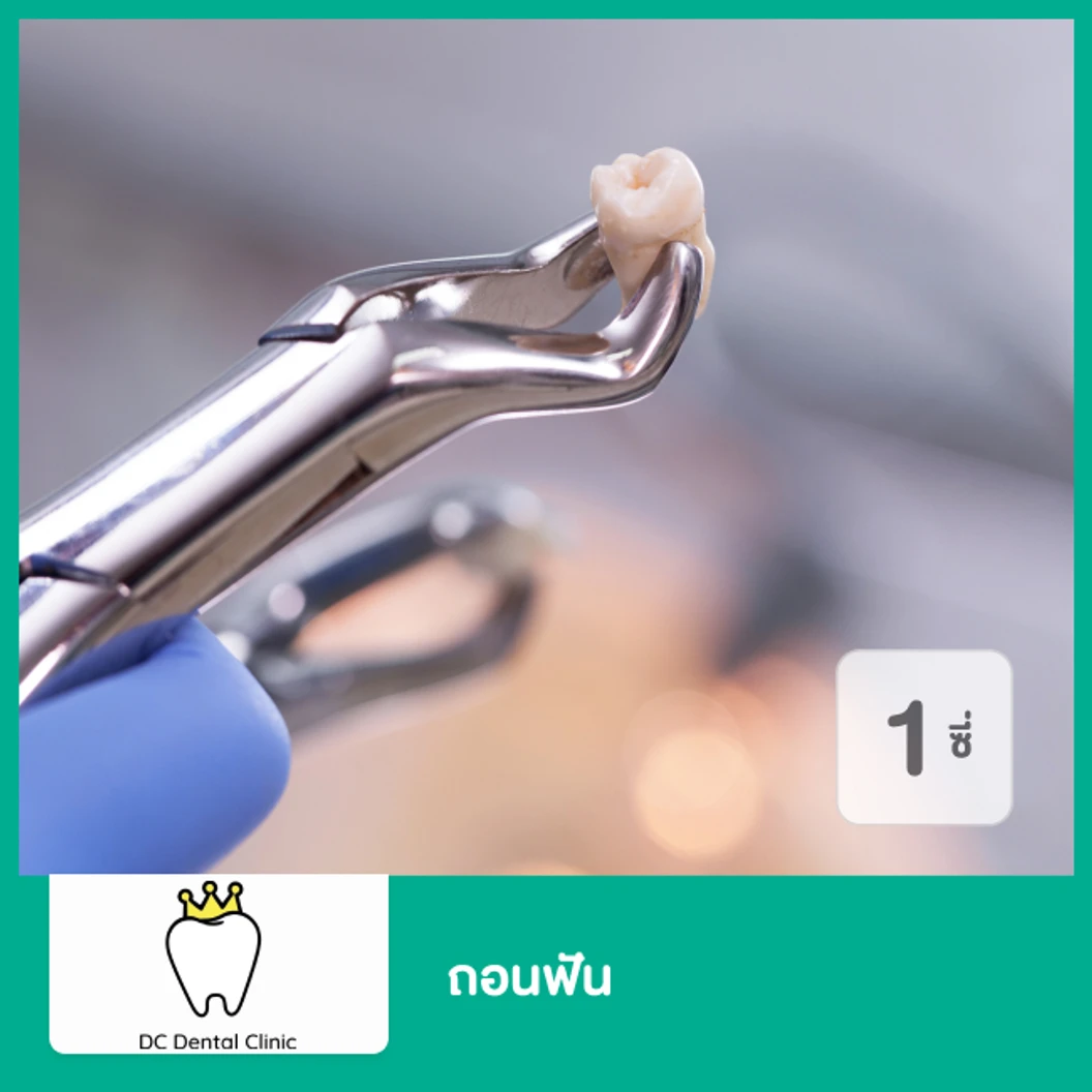 ถอนฟัน 1 ซี่