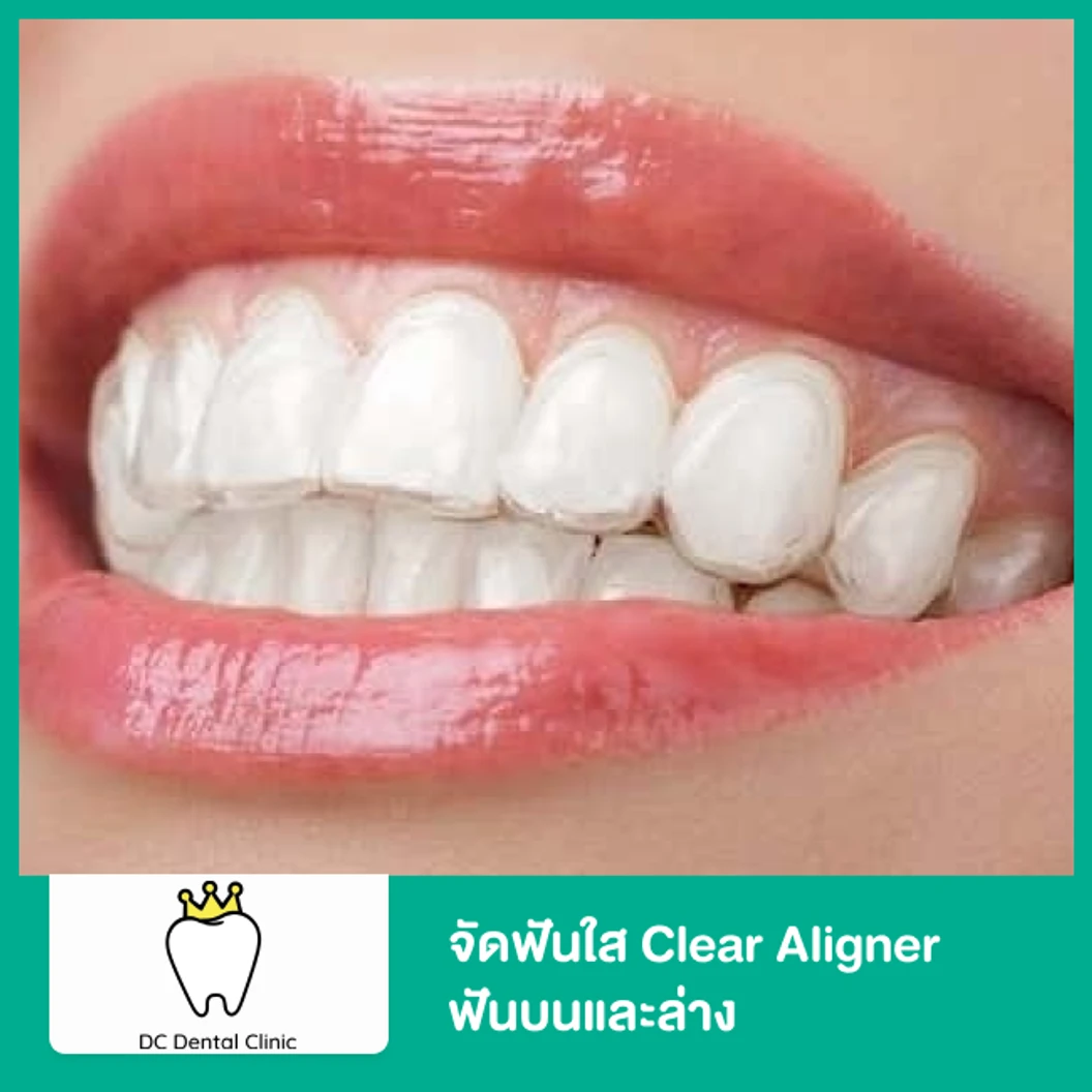 จัดฟันใส Clear Aligner ฟันบนและล่าง