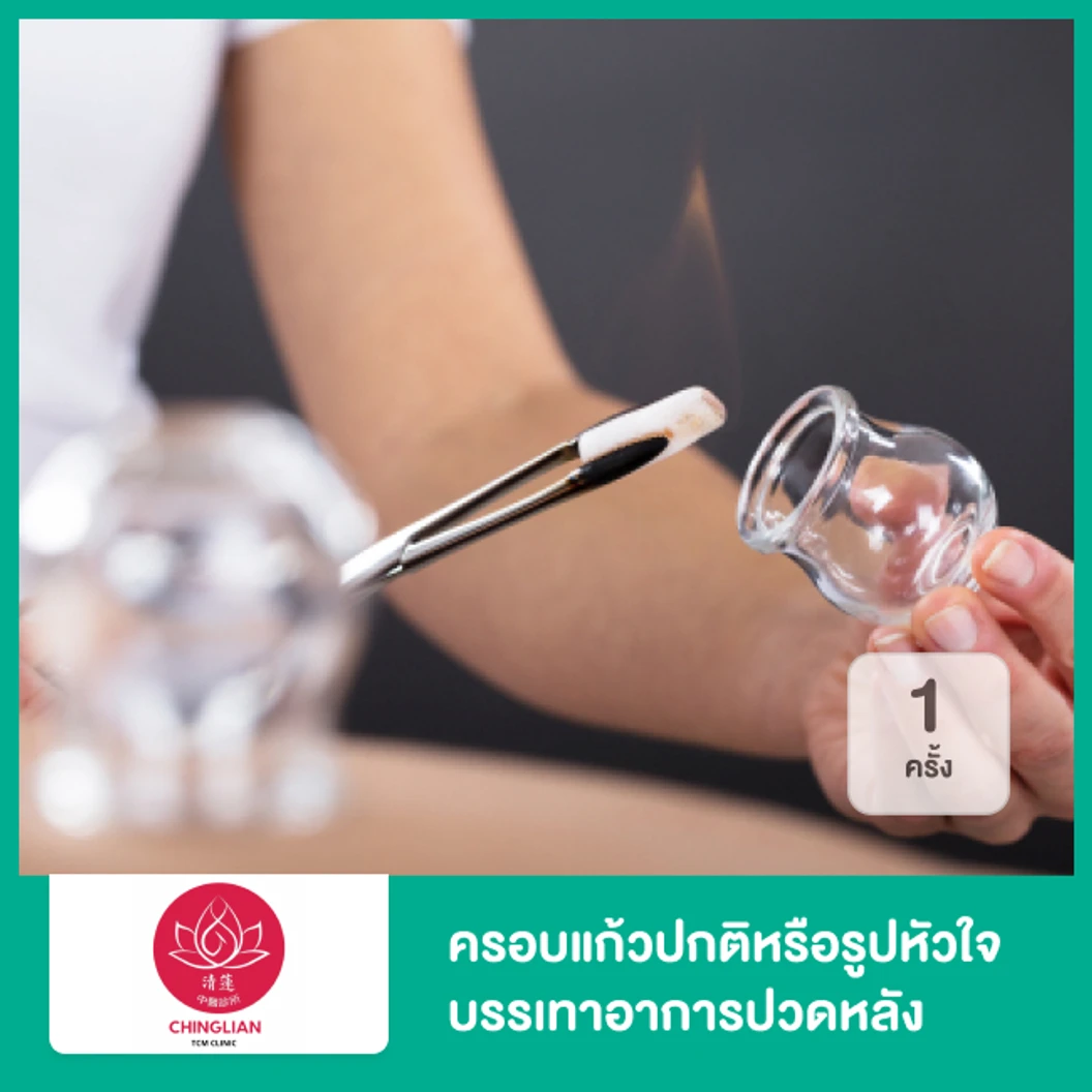 ครอบแก้วปกติหรือรูปหัวใจ (Cupping Therapy) บรรเทาอาการปวดหลัง ออฟฟิศซินโดรม 1 ครั้ง