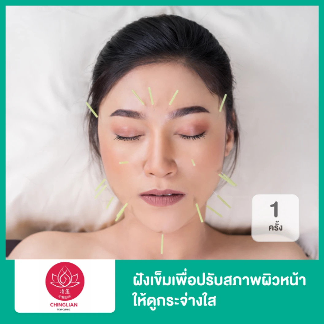 ฝังเข็มเพื่อปรับสภาพผิวหน้าให้ดูกระจ่างใส 1 ครั้ง