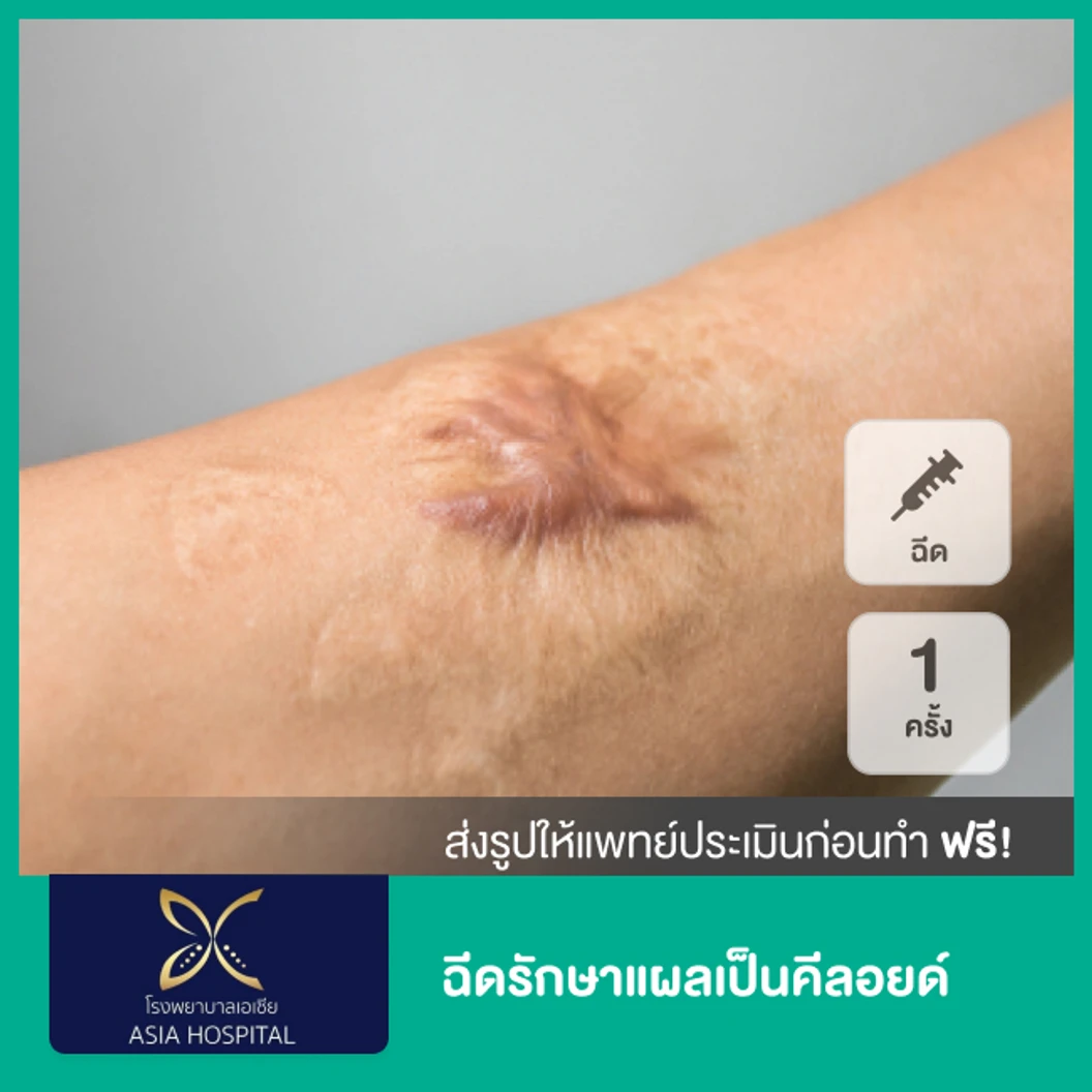ฉีดรักษาแผลเป็นคีลอยด์ 1 ครั้ง