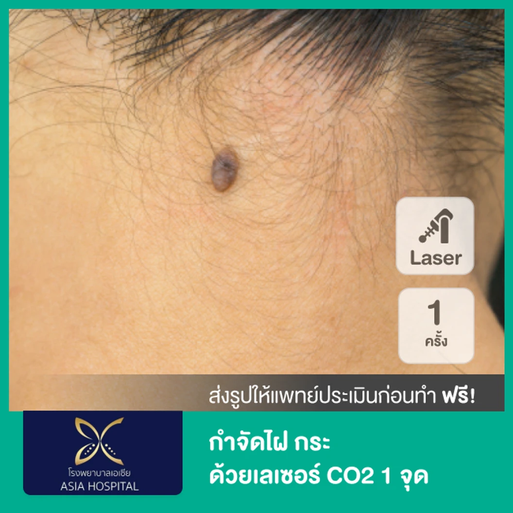 กำจัดไฝ กระ ด้วยเลเซอร์ CO2 1 จุด 1 ครั้ง