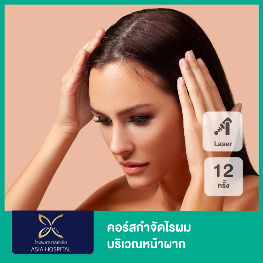 คอร์สกำจัดไรผมบริเวณหน้าผาก ด้วย SHR Laser 12 ครั้ง