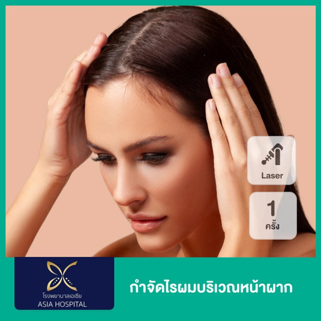 กำจัดไรผมบริเวณหน้าผาก ด้วย SHR Laser 1 ครั้ง