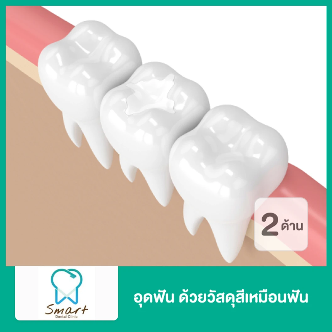 อุดฟัน 2 ด้าน ด้วยวัสดุสีเหมือนฟัน
