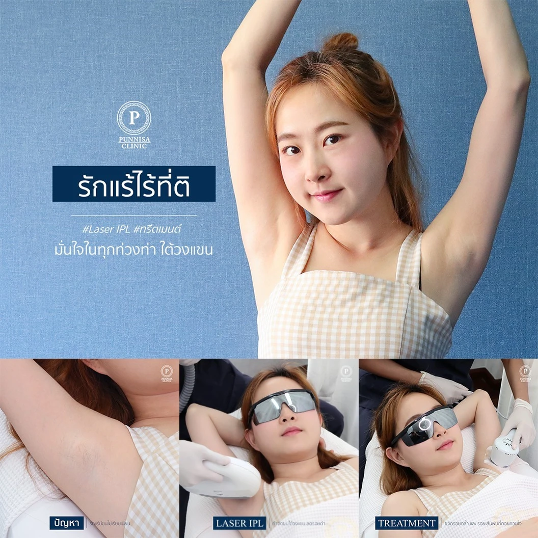 โปรแกรม IPL กำจัดขน + ทำทรีตเมนต์รักแร้ 1 ครั้ง