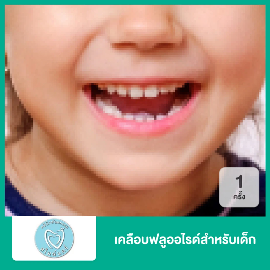เคลือบฟลูออไรด์สำหรับเด็ก 1 ครั้ง